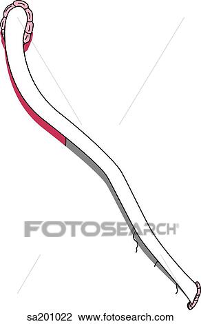 Drawing - Coronary bypass. Middle diversionary channel.. Fotosearch