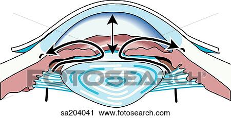 Clip Art - Cross-section of eye showing increased intraocular pressure of glaucoma, caused by restricted flow of aqueous humor.. Fotosearch