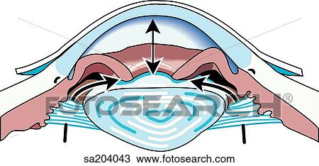Cross-section of eye showing increased intraocular pressure of glaucoma, caused by restricted flow of aqueous humor. View Large Illustration Drawing - Cross-section of eye showing increased intraocular pressure of glaucoma, caused by restricted flow of aqueous humor.. Fotosearch
