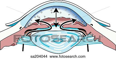 Cross-section of eye showing increased intraocular pressure of glaucoma, caused by restricted flow of aqueous humor. View Large Illustration Stock Illustration - Cross-section of eye showing increased intraocular pressure of glaucoma, caused by restricted flow of aqueous humor.. Fotosearch