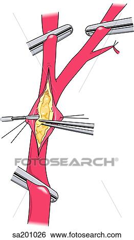 Stock Illustration - Endarterectomy step 2.. Fotosearch