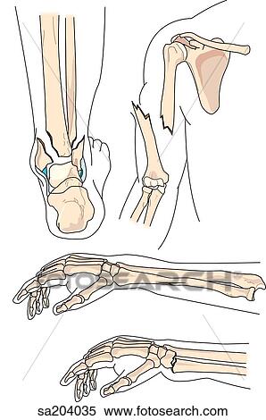 Stock Illustration - Four examples of bone fractures, Pott, open, greenstick, and epiphysial.. Fotosearch