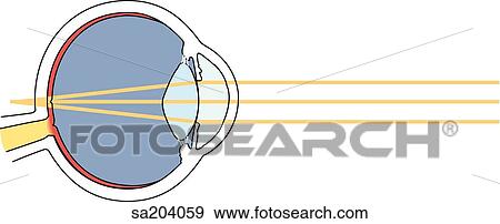 Hyperopia. Hyperopic (farsighted) vision, light rays from close objects come to sharp focus behind retina. View Large Illustration Stock Illustration - Hyperopia. Hyperopic (farsighted) vision, light rays from close objects come to sharp focus behind retina.. Fotosearch