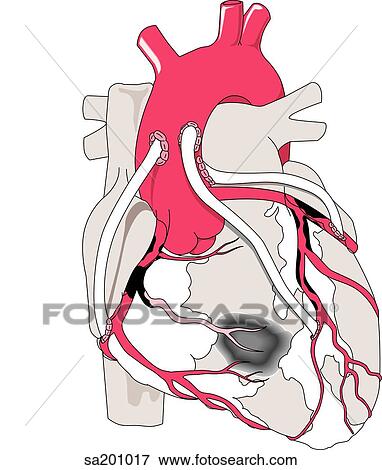 Stock Illustration - Illustration of a completed coronary bypass where new blood flow has been created to the cardiac tissue through diversionary channels.. Fotosearch