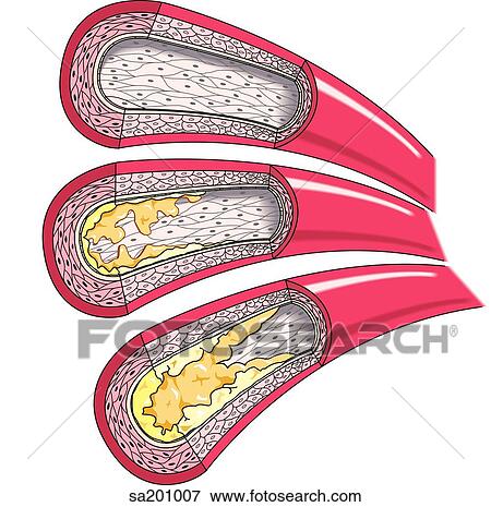 Stock Illustration - Illustration of three progressive stages of atherosclerotic plaque formation.. Fotosearch