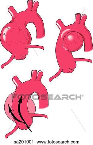 Clip Art - Illustration showing three different types of aortic aneurysms.. Fotosearch