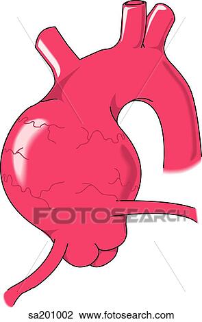 Drawing - Illustration showing type of aortic aneurysm.. Fotosearch