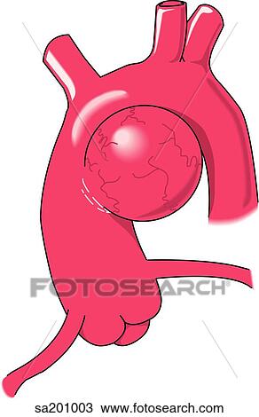 Illustration showing type of aortic aneurysm. View Large Illustration Drawing - Illustration showing type of aortic aneurysm.. Fotosearch