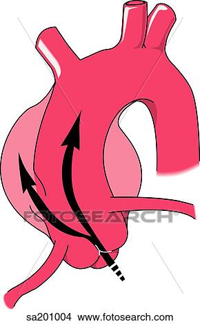 Stock Illustration - Illustration showing type of aortic aneurysm.. Fotosearch