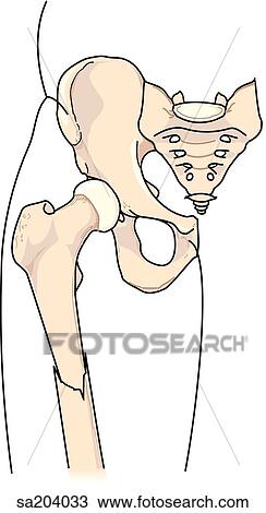 Impacted fracture of the femur. View Large Illustration Drawing - Impacted fracture of the femur.. Fotosearch