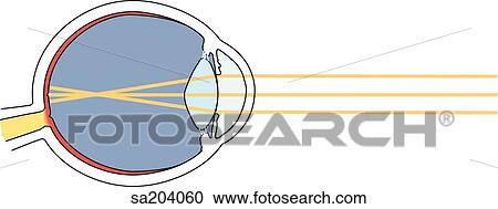 Myopia. Myopic (nearsighted) vision, light rays from a distance come to sharp focus in front of retina. View Large Illustration Clipart - Myopia. Myopic (nearsighted) vision, light rays from a distance come to sharp focus in front of retina.. Fotosearch