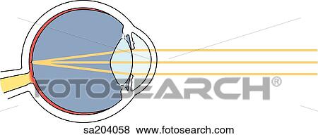 Stock Illustration - Normal (20/20) vision, light rays focus sharply on retina.. Fotosearch