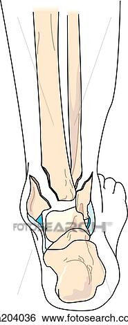 Pott Bimalleolar 骨折 在中 The 胫骨 同时 Fibula 失量图库 Sa4036 Fotosearch