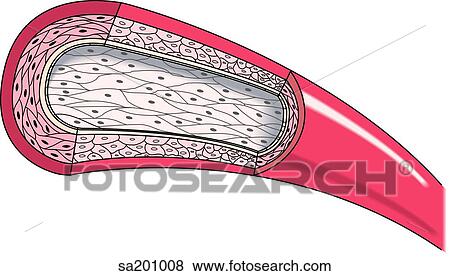 Stock Illustration - Stage 1 of atherosclerotic plaque formation.. Fotosearch