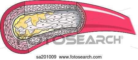 Stock Illustration - Stage 2 of atherosclerotic plaque formation.. Fotosearch