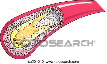 Clipart - Stage 3 of atherosclerotic plaque formation.. Fotosearch