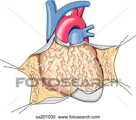Stock Illustration - The heart with pericardial membrane pulled away to reveal the inflammation indicative of pericarditis.. Fotosearch