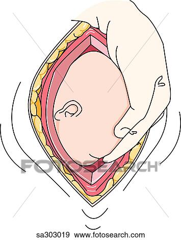 ステップ 5 の A 帝王切開 セクション Delivery イラスト Sa Fotosearch