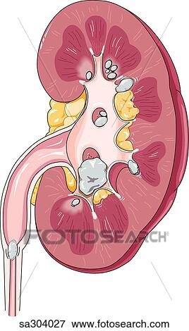 正面 光景 の 腎臓 デモをする タイプ そして 場所 の 腎臓 石 中で 腎臓 Structures イラスト Sa Fotosearch