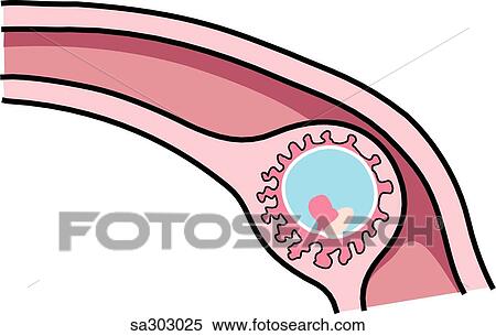 a tubal (ampullar) ectopic pregnancy. View Large Illustration Stock Illustration - a tubal (ampullar) ectopic pregnancy.. Fotosearch