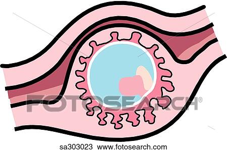 a tubal (isthmic) ectopic pregnancy. View Large Illustration Drawing - a tubal (isthmic) ectopic pregnancy.. Fotosearch