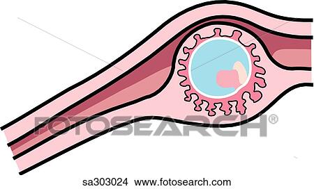 Stock Illustration -  a tubal (isthmic) ectopic pregnancy.. Fotosearch