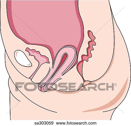 Abnormal positions of the uterus, prolapsed uterus. View Large Illustration Stock Illustration - Abnormal positions of the uterus, prolapsed uterus.. Fotosearch