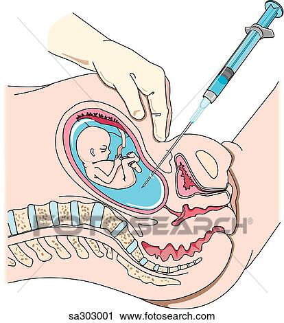 Clip Art - Amniocentesis being performed on a pregnant female.. Fotosearch