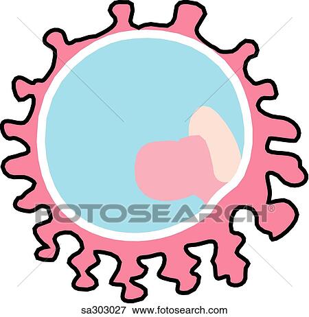 Stock Illustration -  an abdominal ectopic pregnancy.. Fotosearch