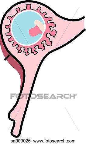 an infundibular ectopic pregnancy. View Large Illustration Stock Illustration - an infundibular ectopic pregnancy.. Fotosearch