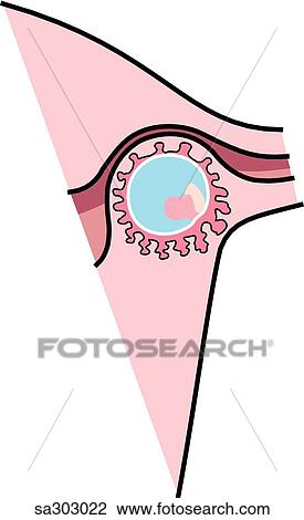 Drawing -  an interstitial ectopic pregnancy.. Fotosearch