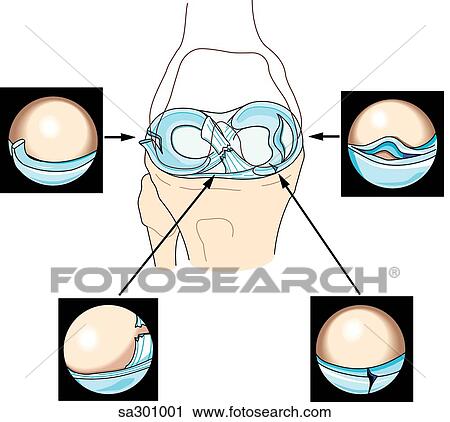 Anterior view of knee joint surrounded by the images one would see arthroscopically. View Large Illustration Clip Art - Anterior view of knee joint surrounded by the images one would see arthroscopically.. Fotosearch