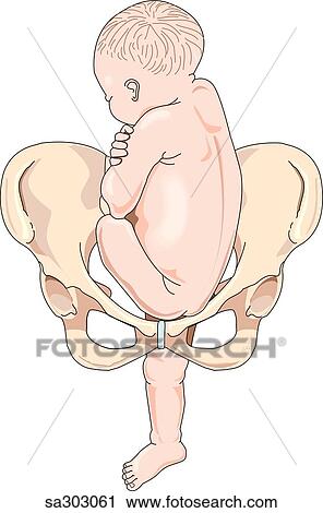 Clip Art - Anterior view of maternal pelvis with a full term fetus in a breech presentation position with one leg protruding.. Fotosearch