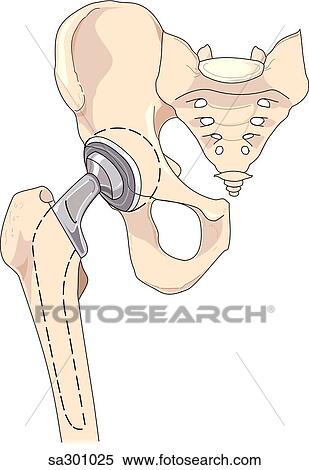 Stock Illustration - Anterior view of pelvic skeleton where the bones that comprise the ball and socket joint of the hip have been replaced with a prosthetic hip.. Fotosearch