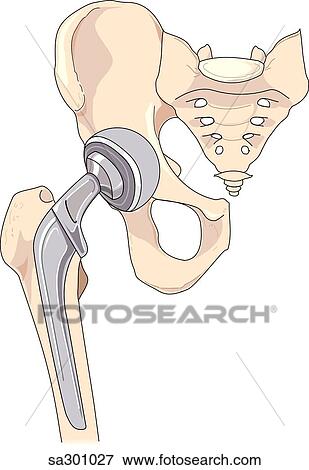 Stock Illustration - Anterior view of pelvic skeleton where the bones that comprise the ball and socket joint of the hip have been replaced with a prosthetic hip (with cut-aways).. Fotosearch