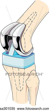 Stock Illustration - Anterolateral view of knee where the bones that comprise the hinge joint have been replaced with a prosthetic knee.. Fotosearch
