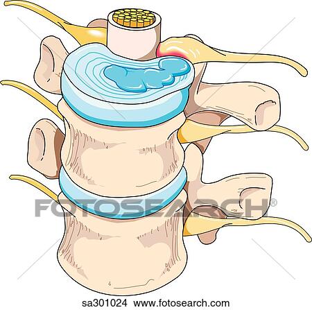 Stock Illustration - Anterosuperior view of portion of spinal column showing a herniation of the intervertebral disk.. Fotosearch