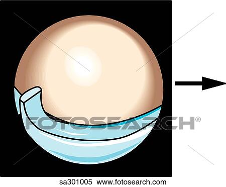 Stock Illustration - Arthroscopic view of knee, lateral meniscal tear.. Fotosearch