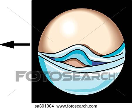 Arthroscopic view of knee, medial meniscal tear. View Large Illustration Stock Illustration - Arthroscopic view of knee, medial meniscal tear.. Fotosearch