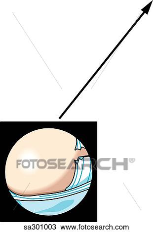 Arthroscopic view of knee, transverse ligament tear. View Large Illustration Drawing - Arthroscopic view of knee, transverse ligament tear.. Fotosearch