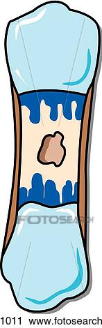 Bone development, stage 3. View Large Illustration Clip Art - Bone development, stage 3.. Fotosearch