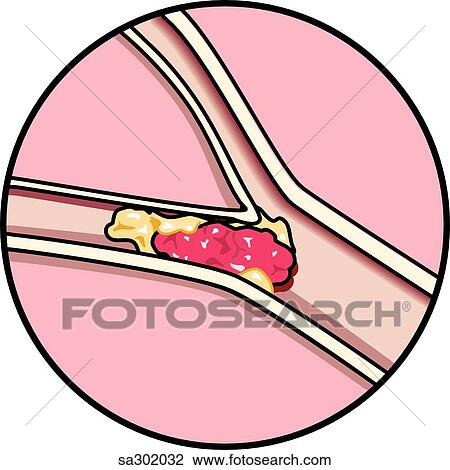Coronal section of brain showing common cause of brain stroke, embolism and atheroschlerosis. View Large Illustration Drawing - Coronal section of brain showing common cause of brain stroke, embolism and atheroschlerosis.. Fotosearch