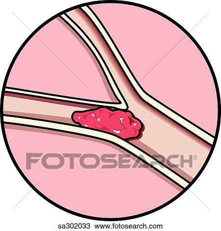 Coronal section of brain showing common cause of brain stroke, embolism. View Large Illustration Drawing - Coronal section of brain showing common cause of brain stroke, embolism.. Fotosearch