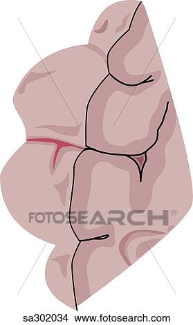 Stock Illustration - Coronal section of brain showing common cause of brain stroke, hemorrhage.. Fotosearch