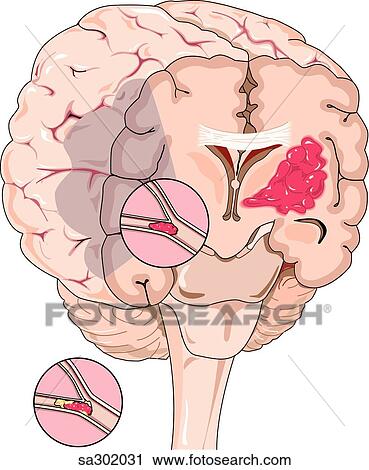 Clip Art - Coronal section of brain showing three common causes of brain stroke, hemorrhage, embolism and atheroschlerosis.. Fotosearch