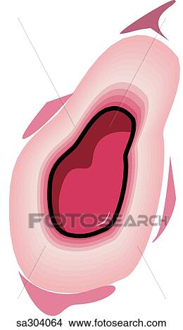 Stock Illustration - Duodenum ulcer.. Fotosearch