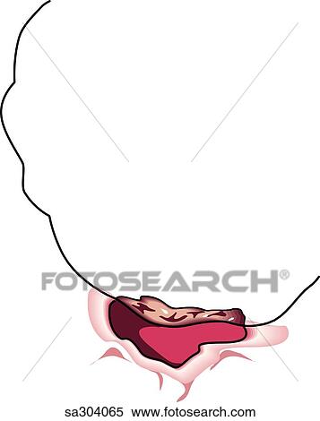 Duodenum ulcer. View Large Illustration Stock Illustration - Duodenum ulcer.. Fotosearch