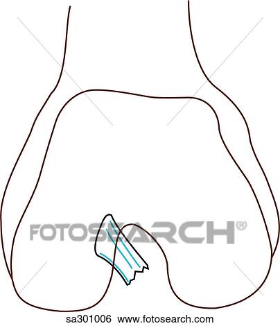 Stock Illustration - Femur and anterior cruciate ligament.. Fotosearch