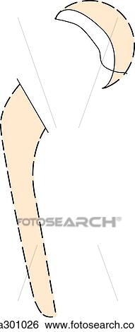 Stock Illustration - Hip replacement cut-aways.. Fotosearch