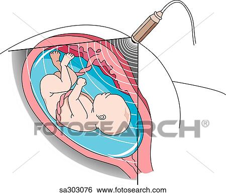 Illustration demonstrating the principles of obstetrical ultrasound. View Large Illustration Stock Illustration - Illustration demonstrating the principles of obstetrical ultrasound.. Fotosearch